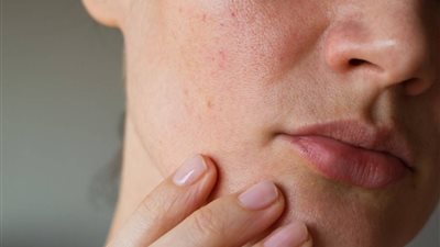 بطرق طبيعية وفعّالة.. كيفية التحكم في دهون البشرة